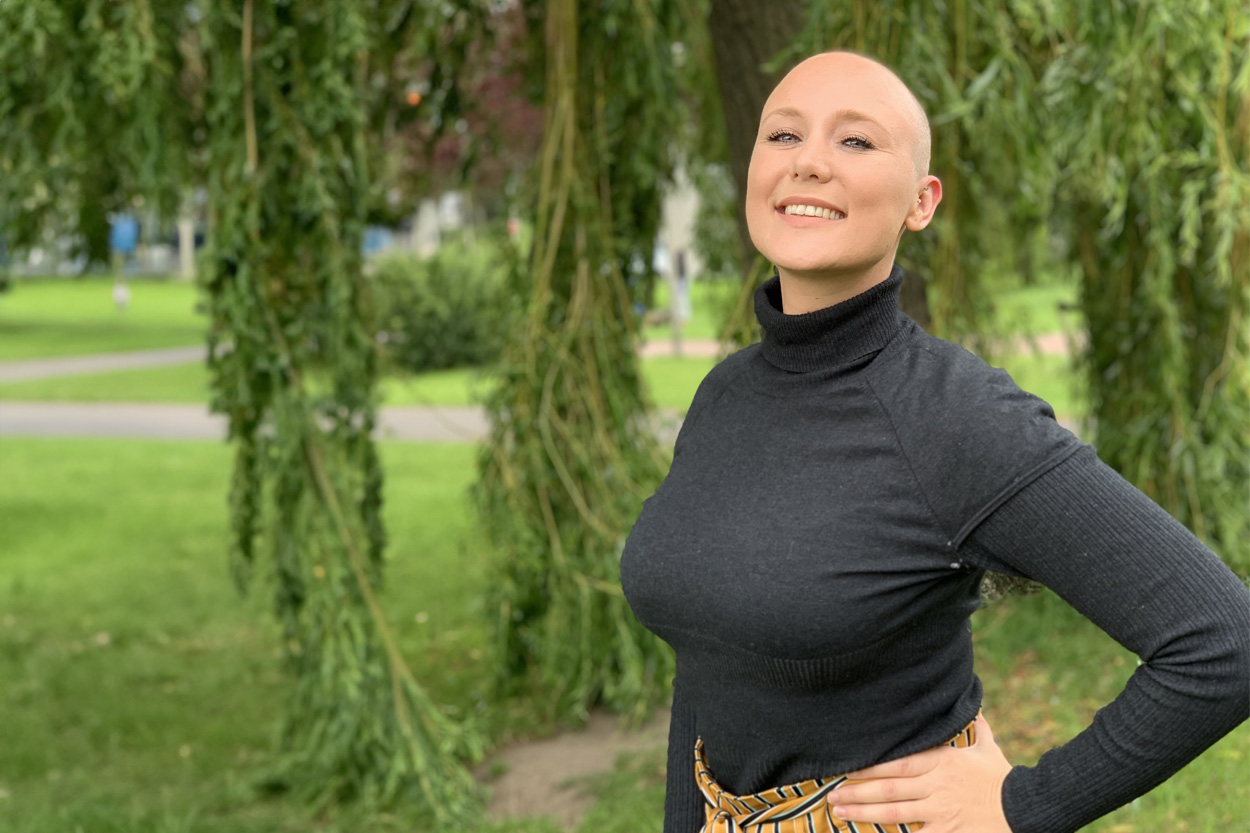 Vrouw met alopecia areatis